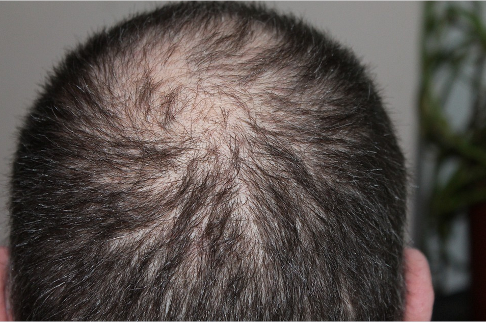 Tips for Choosing Your Hair Transplant Surgeon